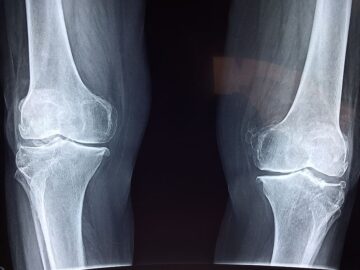 علاج طبيعي للركبة والمفاصل